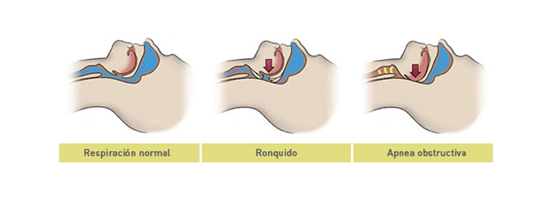 Tratamiento de los ronquidos- Apnea del sueño - Clínica dental