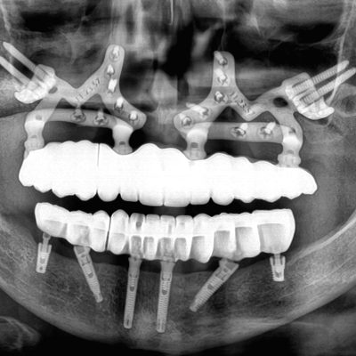 Radiografía donde se puede observar el anclaje de las mallas subperiosticas en los dos maxilares