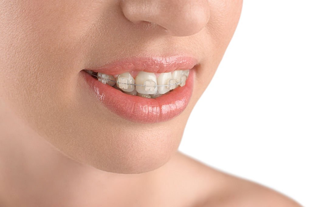 mujer con ortodoncia de zafiro sonriendo